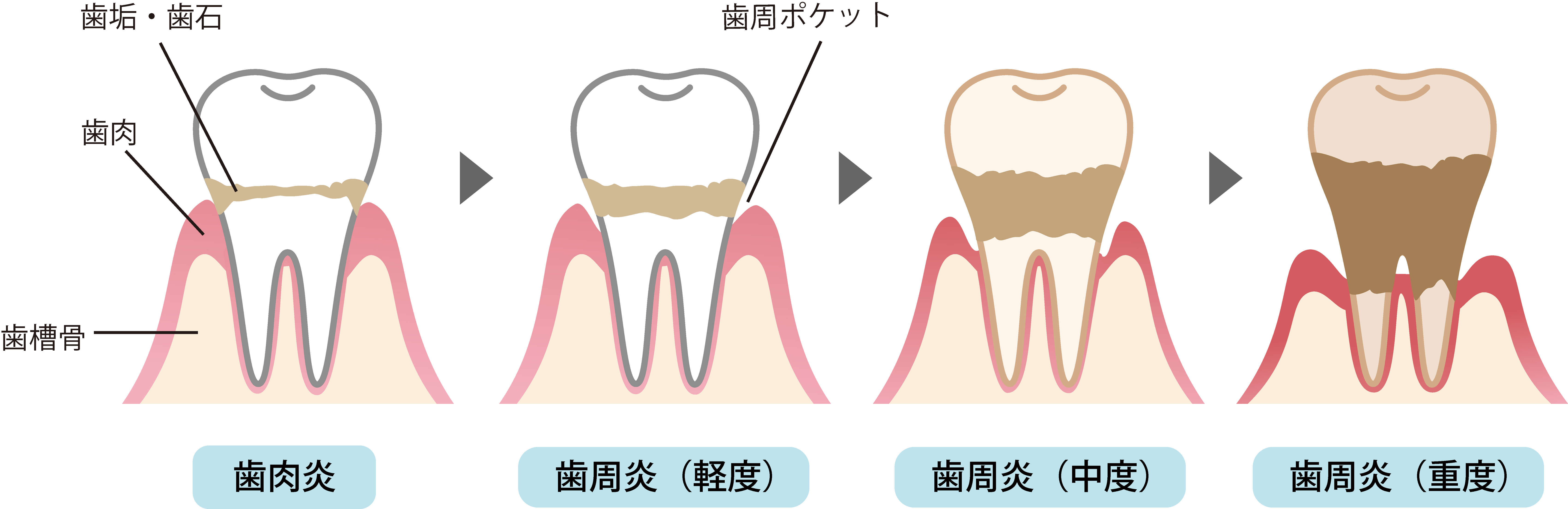 歯周病の進行症状と治療について